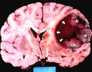 Una pastilla consigue detener varios años el avance de un tumor cerebral maligno