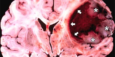 Una pastilla consigue detener varios años el avance de un tumor cerebral maligno