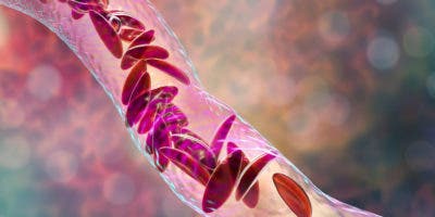 La nueva terapia génica para pacientes con anemia de células falciformes
