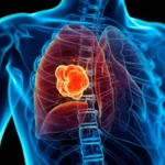 Tratamiento sin quimioterapia ofrece mejores resultados a pacientes con cáncer de pulmón