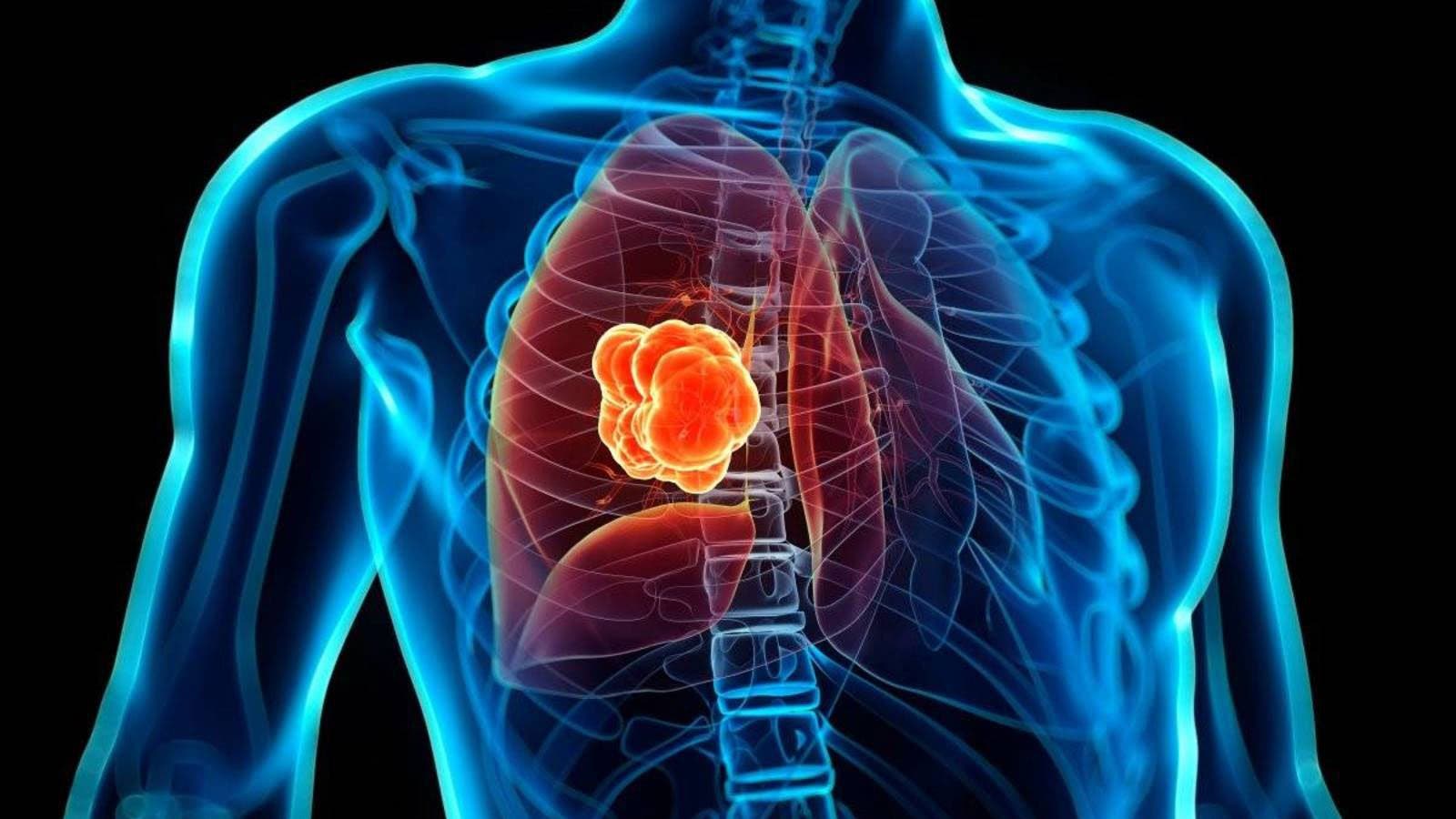 Un nuevo tratamiento aumenta la supervivencia en pacientes con cáncer de pulmón