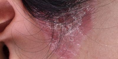 La dermatitis atópica afecta a 230 millones