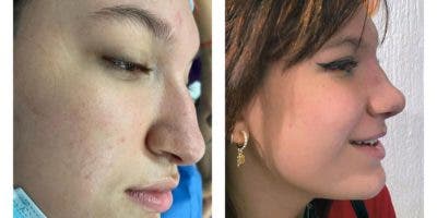 El uso del maquillaje  luego de una cirugía
