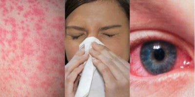 Hoy es el Día Mundial de la Alergia