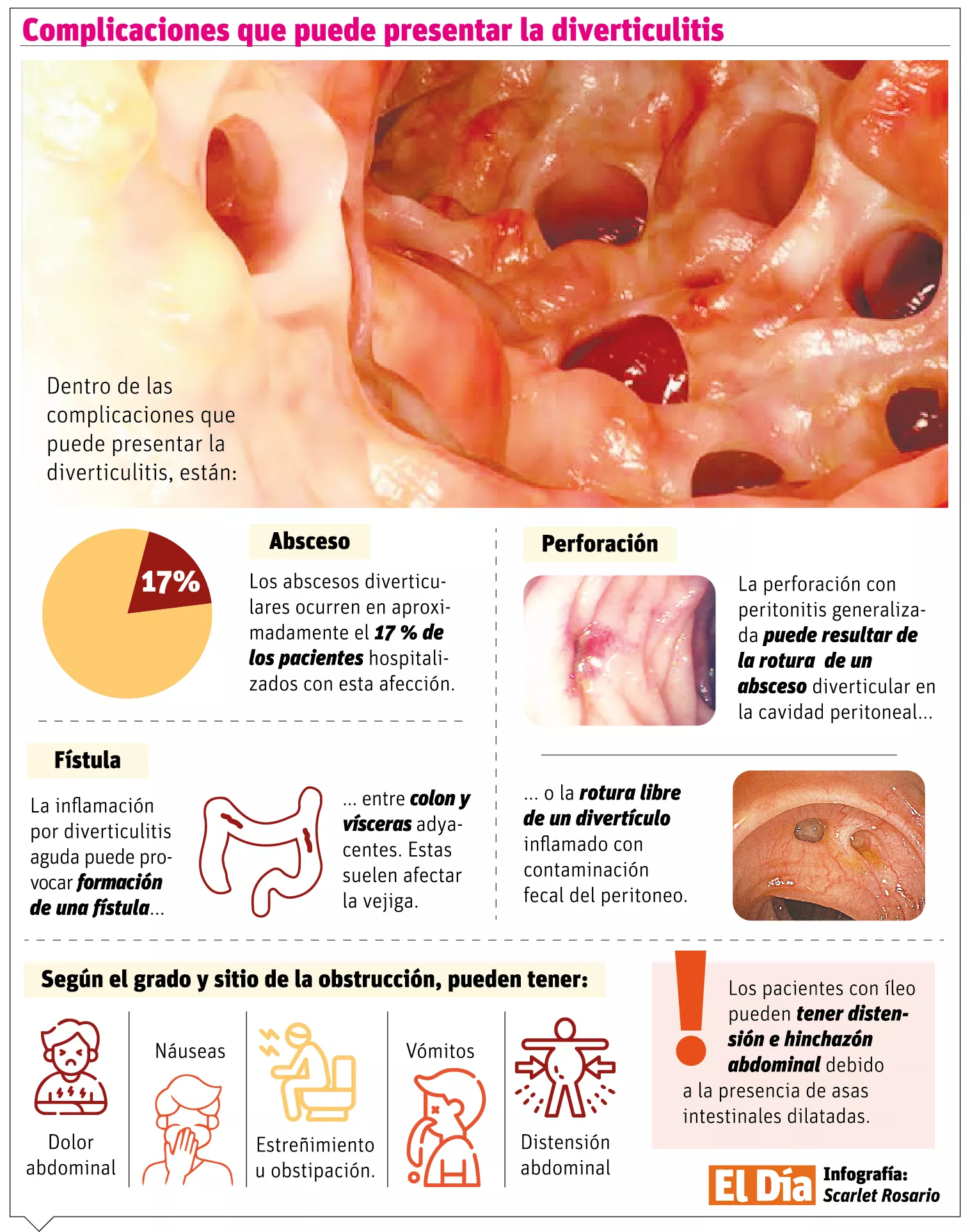 Síntomas y complicaciones de  la diverticulitis, una enfermedad en el colon