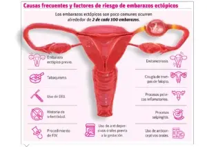 Embarazo ectópico causa del 10 al 15  %  muertes maternas