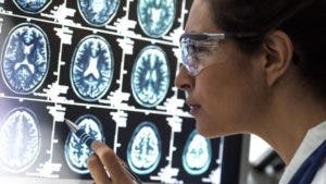 Dos buenas noticias sobre el tratamiento del Alzheimer y una mala de otras formas de demencia