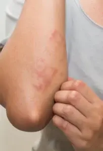 Dermatitis atópica no es contagiosa, sí irritante