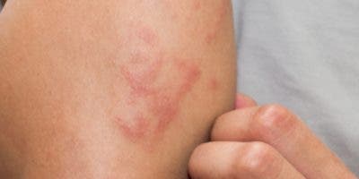 Dermatitis atópica no es contagiosa, sí irritante
