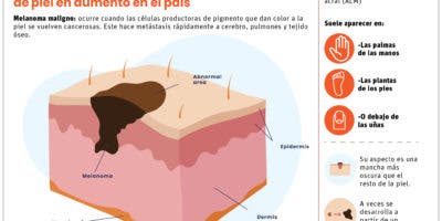 Especialistas detectan aumentos de melanoma, cáncer de piel más letal