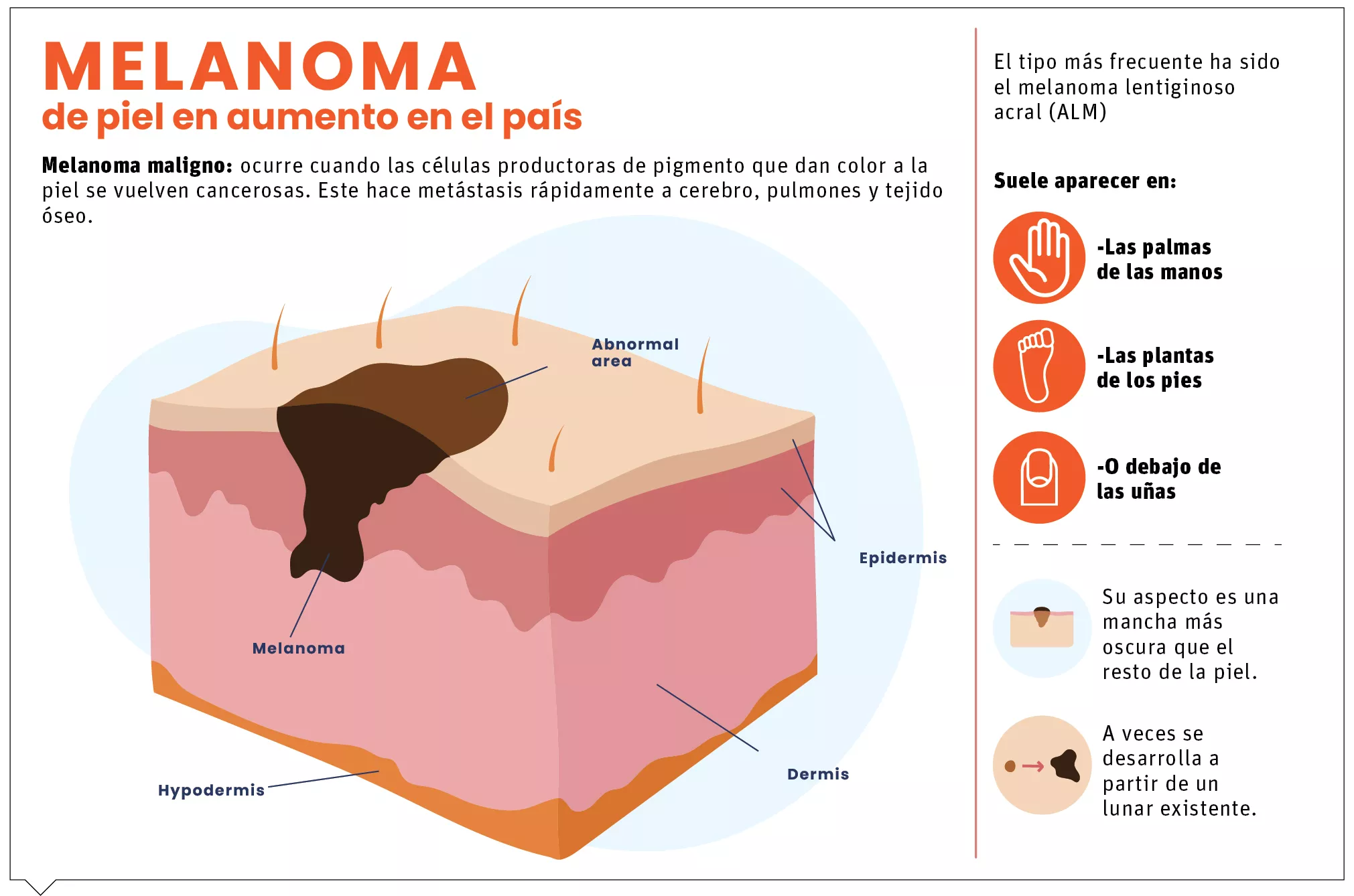 Especialistas detectan aumentos de melanoma, cáncer de piel más letal