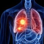 Medicina de precisión en cáncer de pulmón