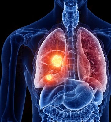 Medicina de precisión en cáncer de pulmón