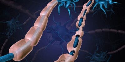 Una herramienta de inteligencia artificial predice la evolución de la esclerosis múltiple