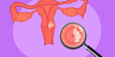 Una nueva prueba para detectar el cáncer de útero reduce la mayoría de falsos positivos
