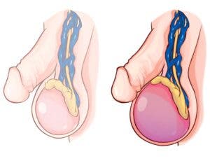 Despejando dudas cuando se presenta  la inflamación escrotal