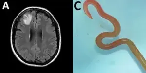 El gusano vivo en el cerebro de una mujer y otras noticias de salud que impactaron el 2023