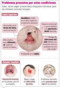 Labio leporino y paladar hendido: debe mejorar estigma y la atención