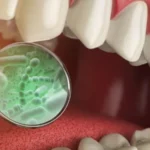 4 enfermedades vinculadas a las bacterias de tu boca