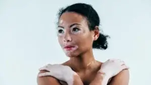 Vitiligo, la enfermedad de la piel que a pesar de ser común es muy poco conocida