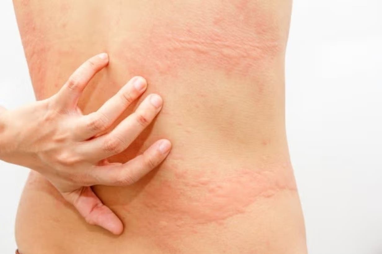 Ronchas y picor, formas frecuentes de alergias
