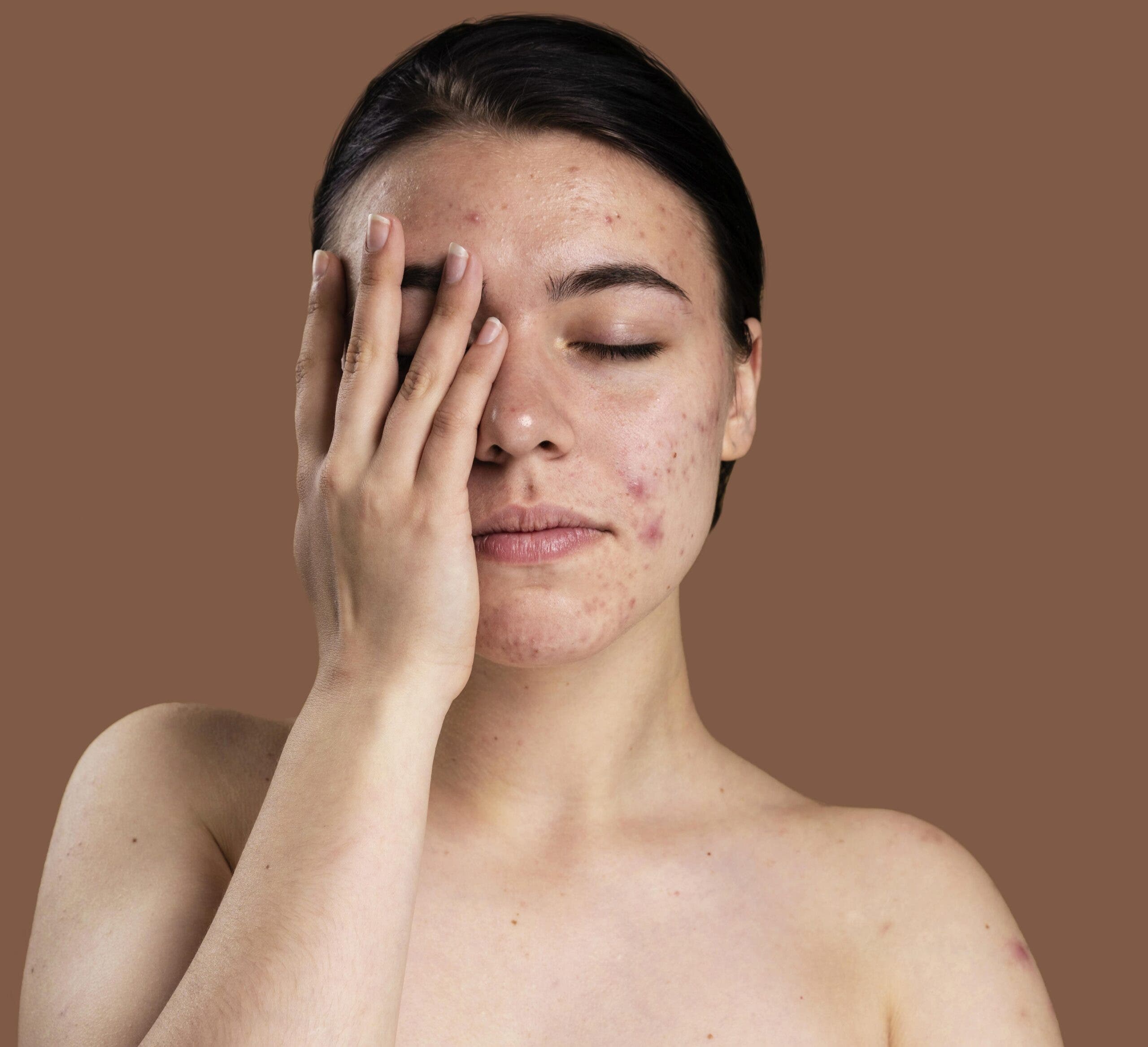 El acné afecta la piel y emociones de las personas