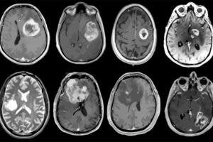 Médicos ven ahora más tumores cerebrales por más herramientas diagnósticas disponibles