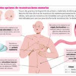 Los pro y contra de una reconstrucción mamaria