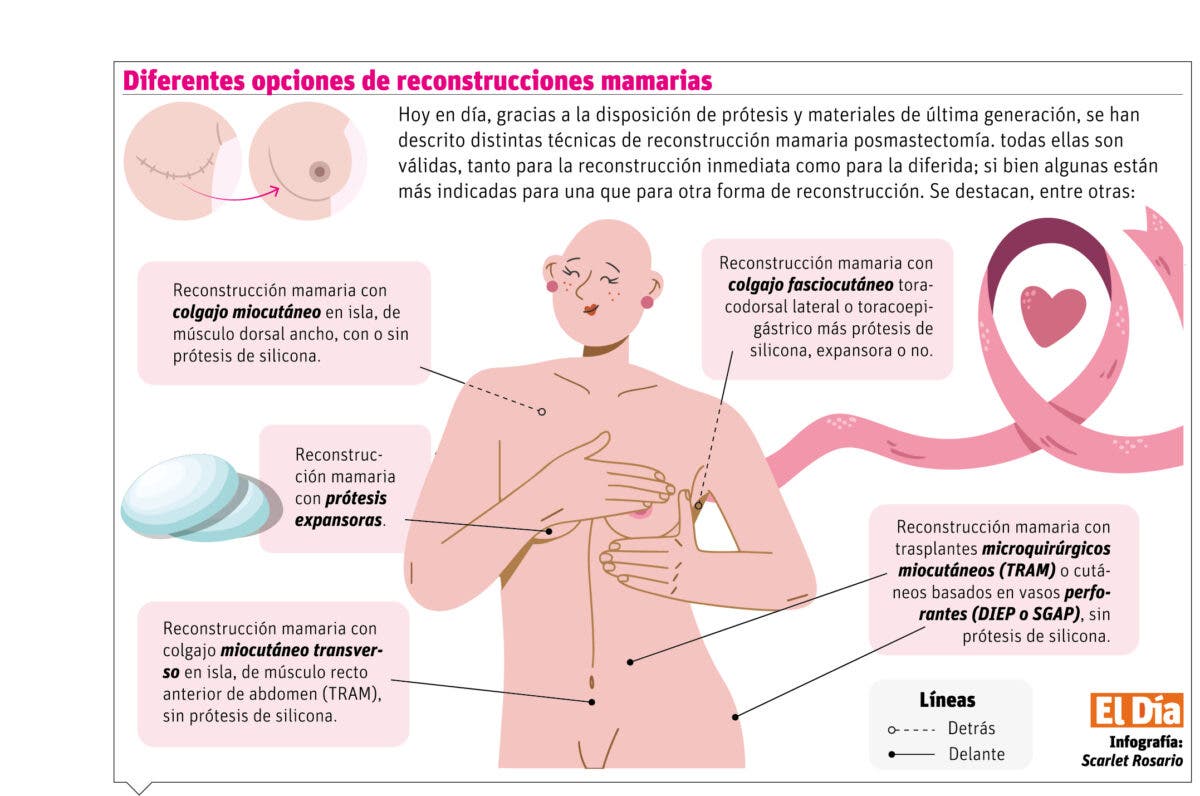 Los pro y contra de una reconstrucción mamaria