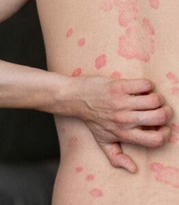 Psoriasis va más allá de una enfermedad de piel