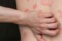 Psoriasis va más allá de una enfermedad de piel