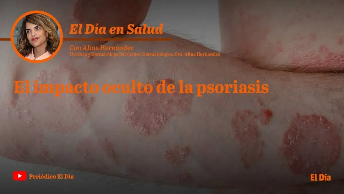 El impacto oculto de la psoriasis