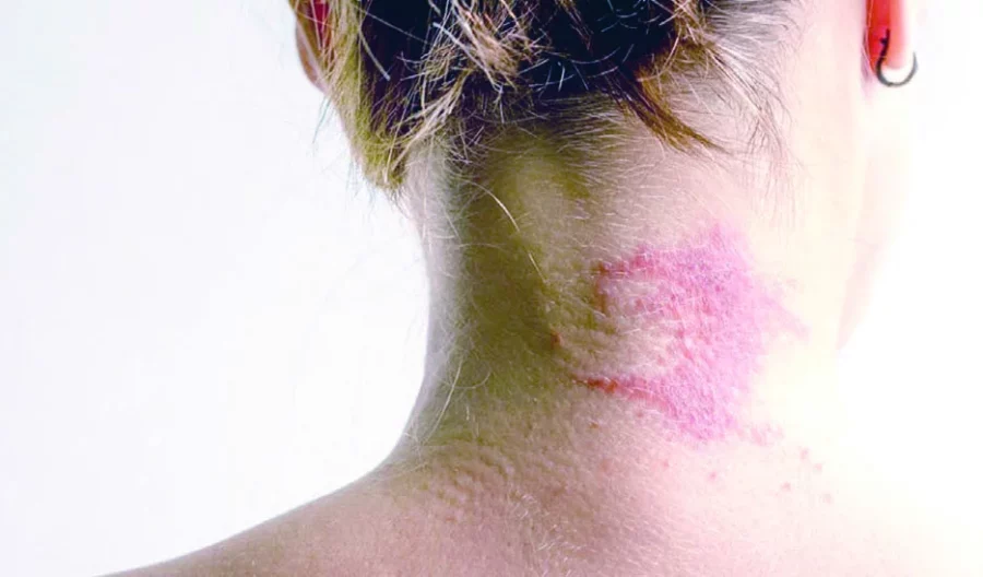 dermatitis1 dermatitis1