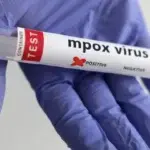 Francia detecta el primer caso del virus de mpox 1b