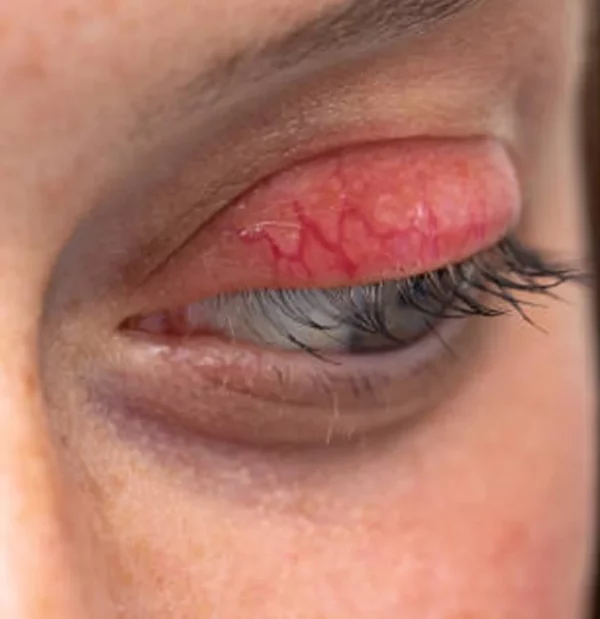 La blefaritis es una condición crónica que requiere control.