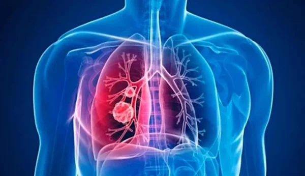 La hipertensión pulmonar se define como la elevación por encima de los valores normales de presión en la arteria pulmonar.