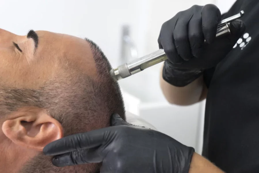 trasplante de pelo trasplante de pelo