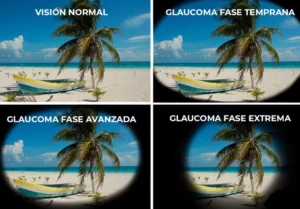 Visión con Glaucoma.