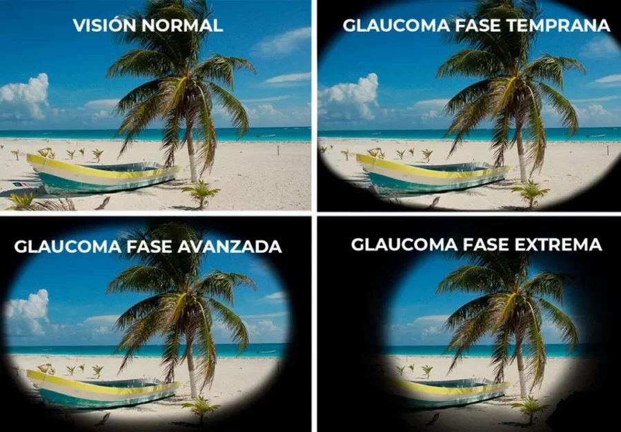 Visión con Glaucoma.