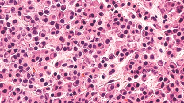 myeloma (1)