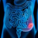 Cáncer de colon: detectarlo a tiempo salva hasta el 90 % de los pacientes