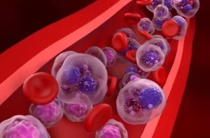 El mieloma múltiple es uno de los cánceres más frecuentes de la sangre.