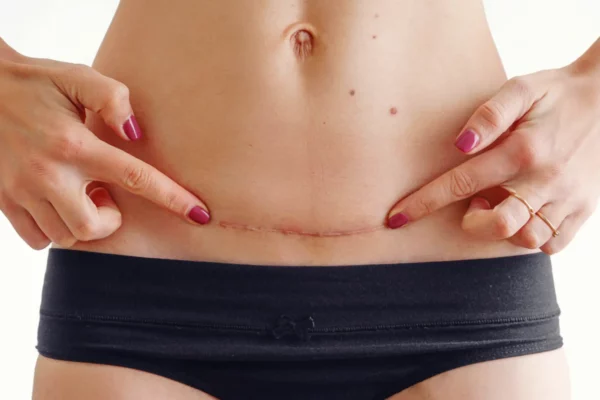 cesarea-recuperacion-guia-04