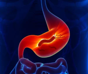 Gastritis, úlceras y hepatitis están entre causas más frecuentes de visitas al gastroenterólogo