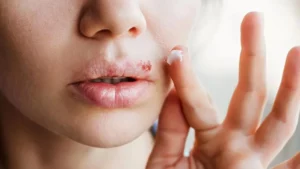 ¿Herpes labial y Alzheimer? Científicos descubren una posible conexión