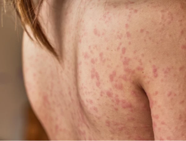 acrodermatitis