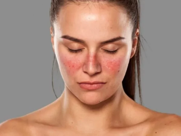 lupus-enfermedad-cancer