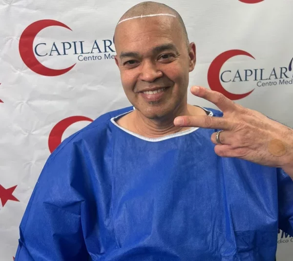 Alex Bueno con implante capilar