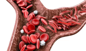 Este jueves se conmemora Día Mundial de Anemia Falciforme