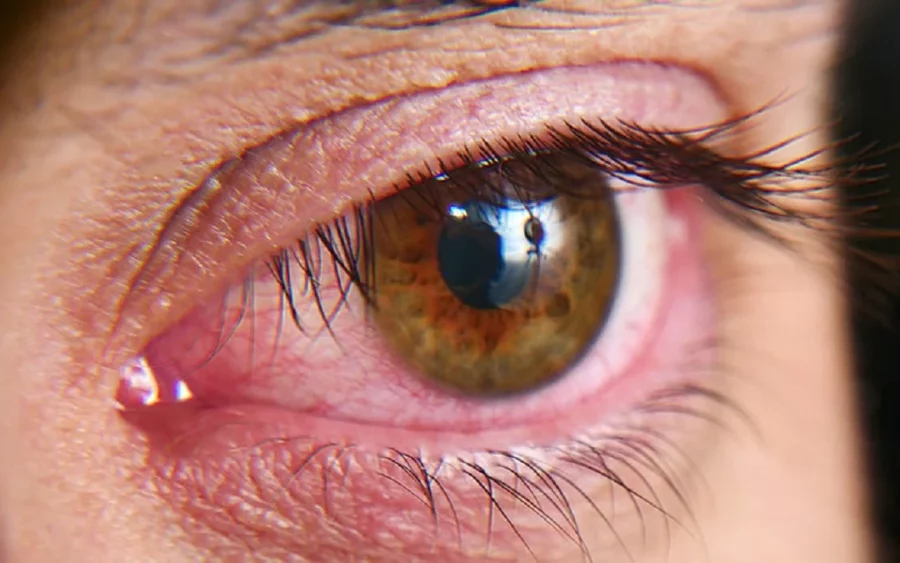 Características de un ojo seco. Características de un ojo seco.